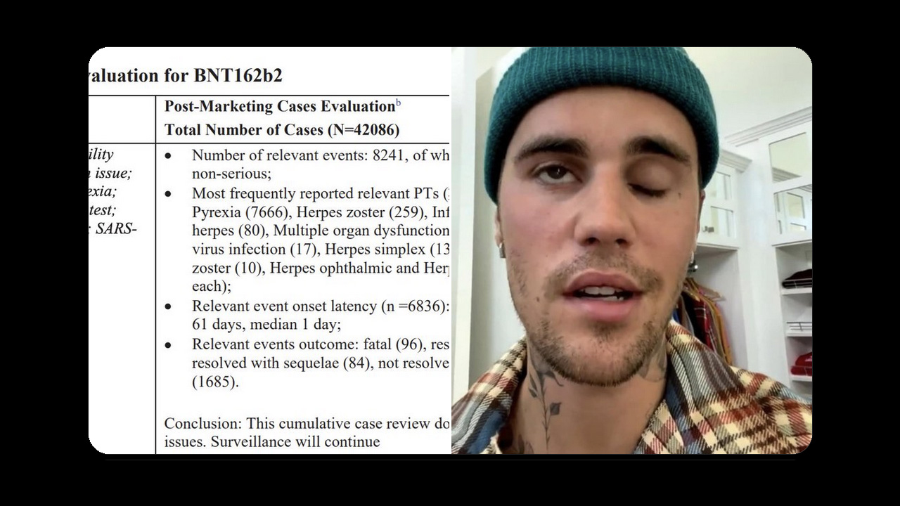 If Justin Bieber Received The Pfizer Injection: Here’s What’s Wrong With His Face [IN PFIZER’S OWN WORDS]